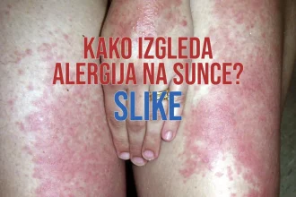 Kako izgleda alergija na sunce SLIKE