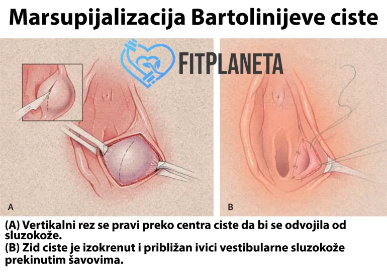 Marsupijalizacija Bartolinijeve ciste