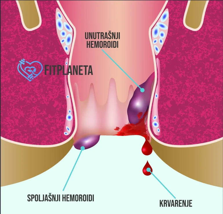 Spoljašnji i unutrašnji hemoroidi