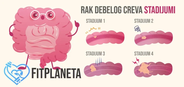 Tumor debelog creva Stadijumi