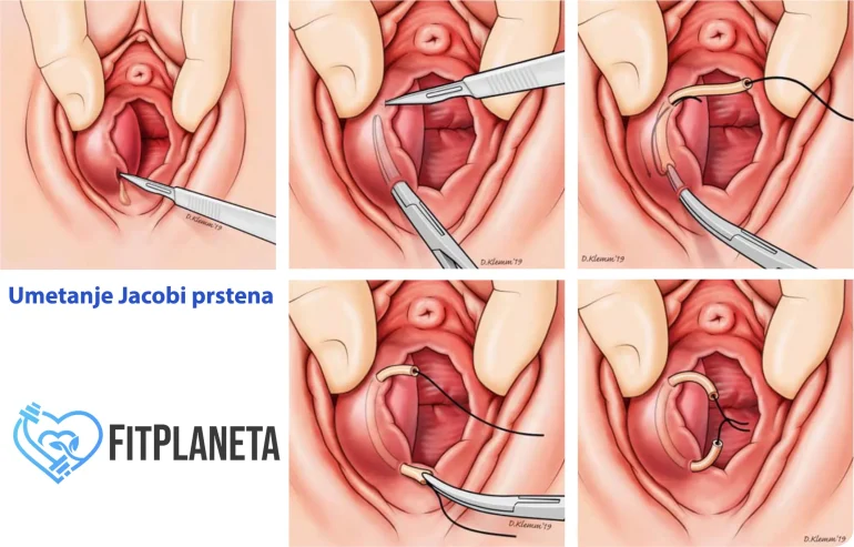 Umetanje Jacobi prstena