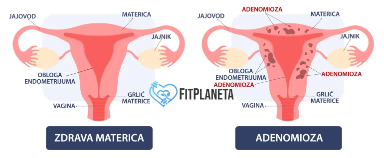 Zdrava materica i Adenomioza